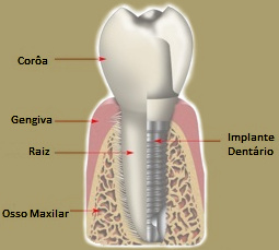 Implante Dentário