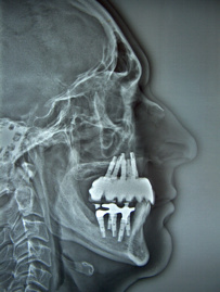 Implantes Dentários - Vista Raio X